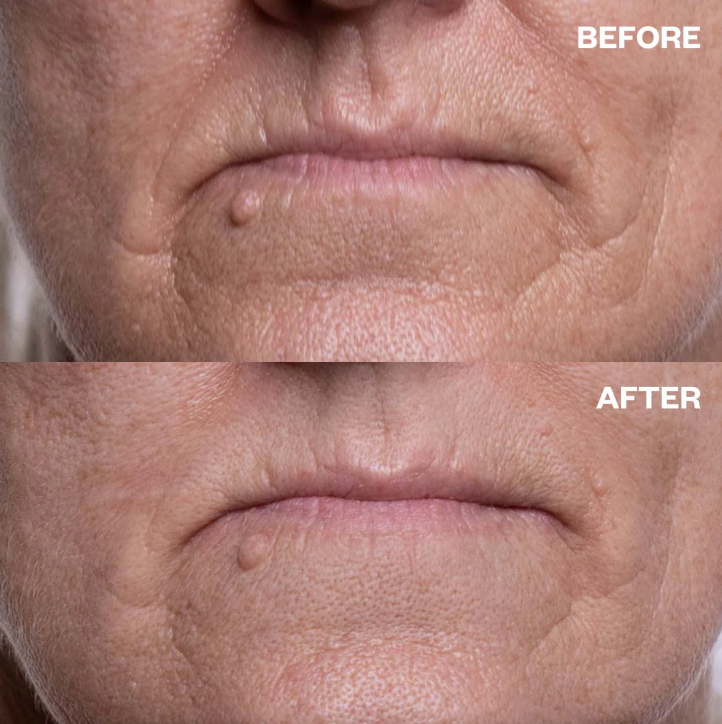 Mouth & Lip Wrinkle Patches