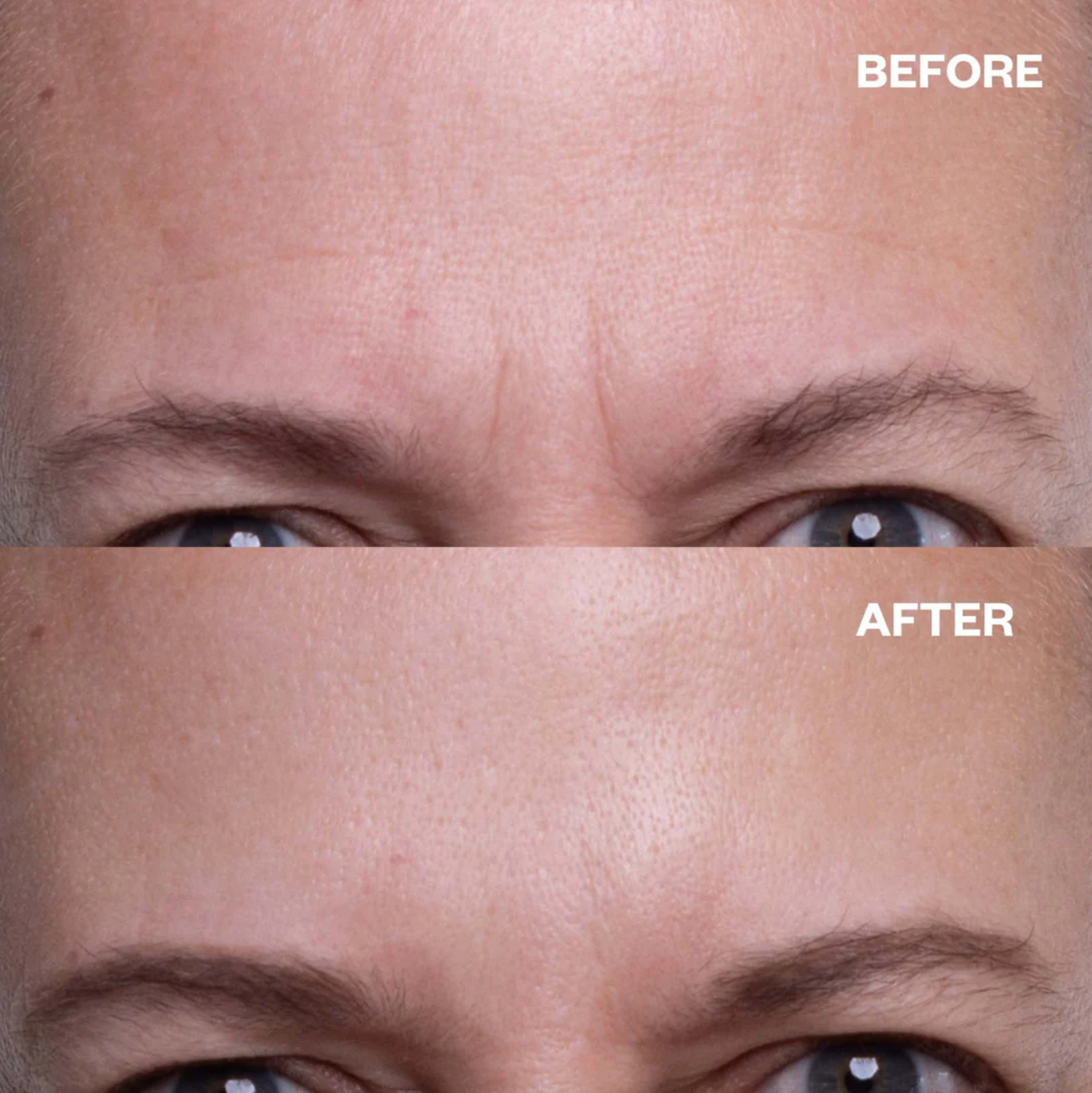 Forehead Wrinkle Patch